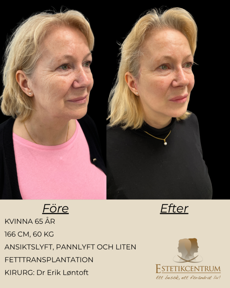 Foreefter-2026-META-10.png