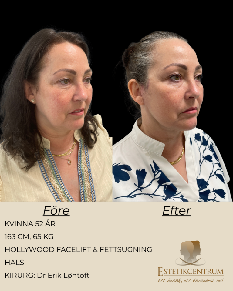 Foreefter-2026-META-9.png