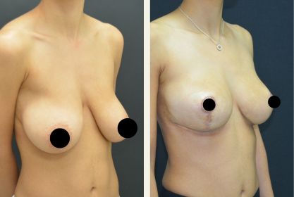 Före- och efterbild på bröstförminskning med bröstlyft på Estetikcentrum