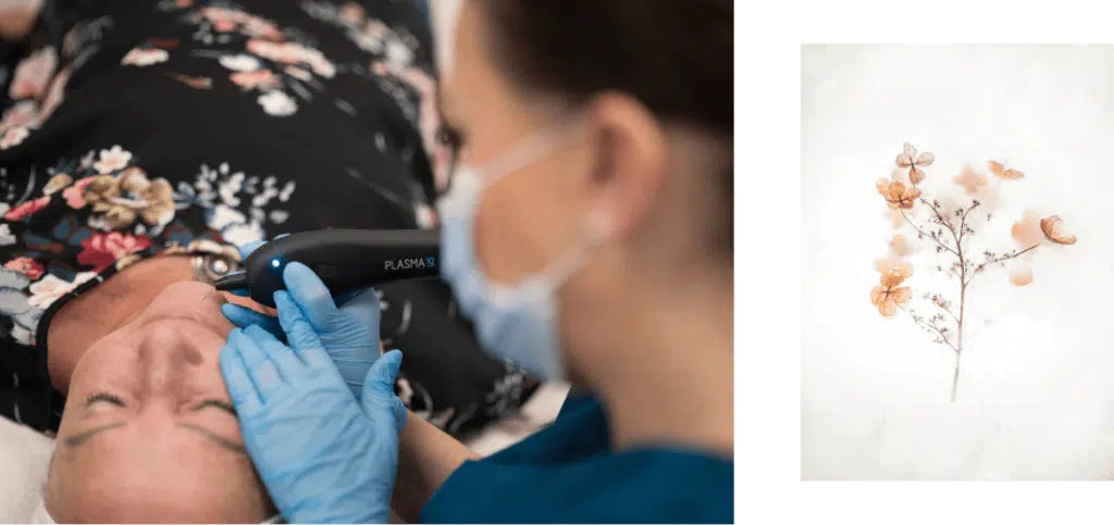 Plasma pen treatment of crow's feet