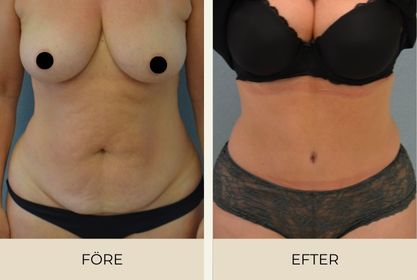 Before and after pictures of woman after abdominoplasty performed at Estetikcentrum