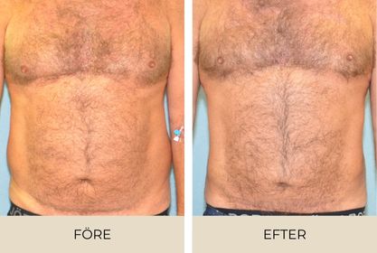 Före och efter bilder på man efter fettsugning utförd på Estetikcentrum