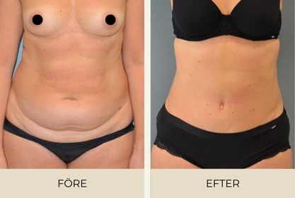 Before and after pictures of woman after abdominoplasty performed at Estetikcentrum