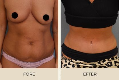 Before and after pictures of woman after abdominoplasty performed at Estetikcentrum