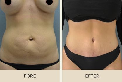 Before and after pictures of woman who had abdominoplasty at an aesthetic center in Malmö