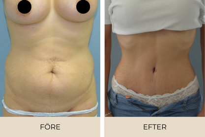 Before and after pictures of woman who had abdominoplasty at an aesthetic center in Malmö