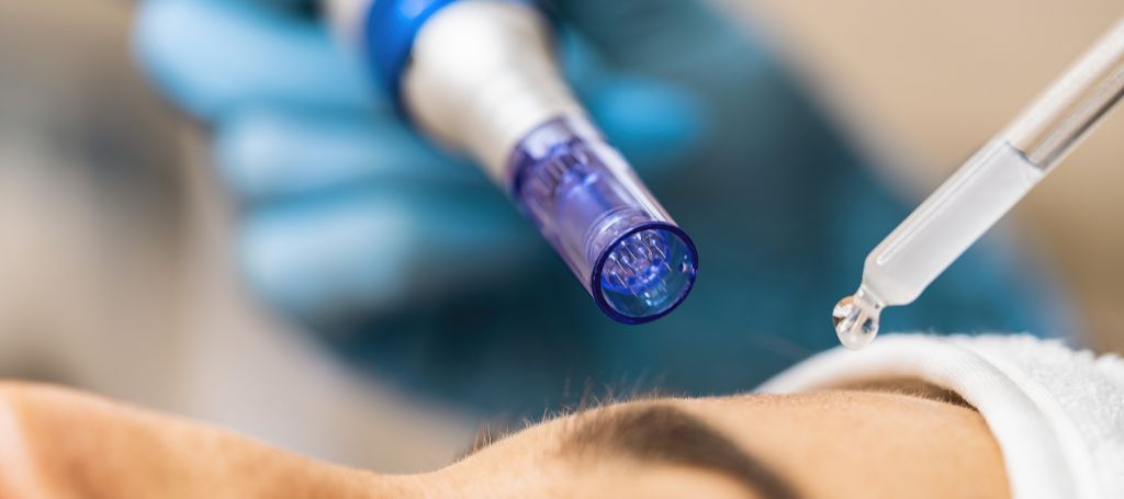 Så fungerar microneedling: Fördelar, risker och vad du kan förvänta dig