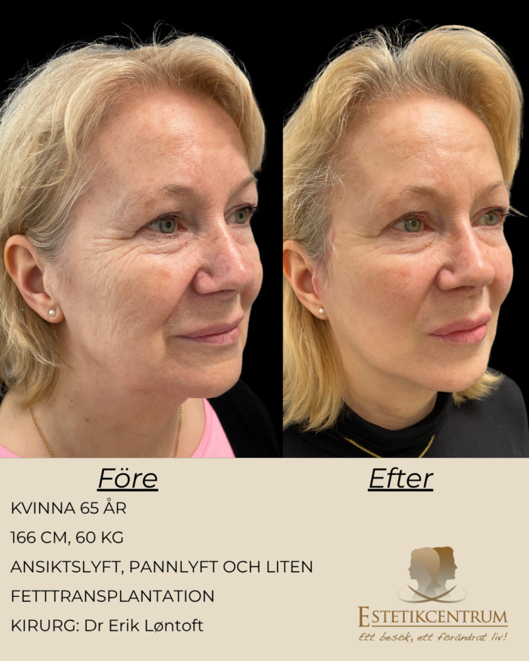 Foreefter-2026-META-34.png
