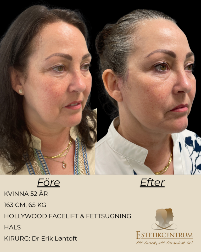 Foreefter-2026-META-38.png